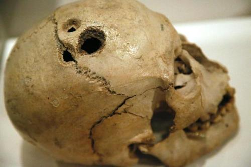Trepanning involves the drilling of holes through the skull