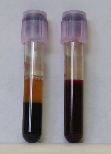 LEFT: Clotted and Separated Blood RIGHT: Unclotted Blood